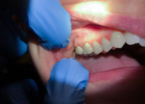 Best Emergency Treatment for Toothache in Lyons, IL